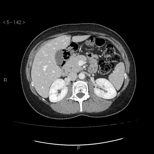 Adult transient intestinal intussusception (Radiopaedia 34853-36310 Axial C+ portal venous phase 16).jpg