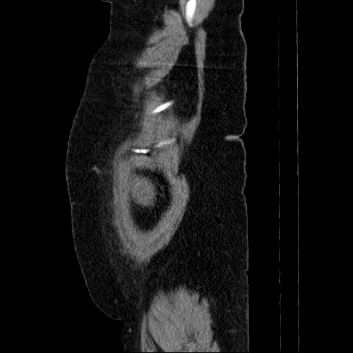 File:Afferent loop syndrome - secondary to incarcerated trocar site hernia (Radiopaedia 82959-97305 Sagittal C+ portal venous phase 7).jpg