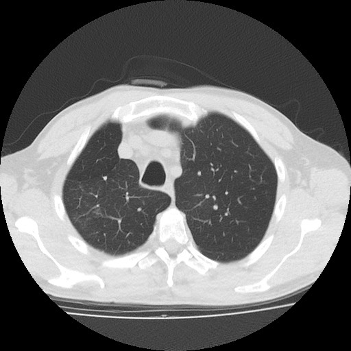 Allergic bronchopulmonary aspergillosis (ABPA) (Radiopaedia 60594-68313 Axial lung window 12).jpg