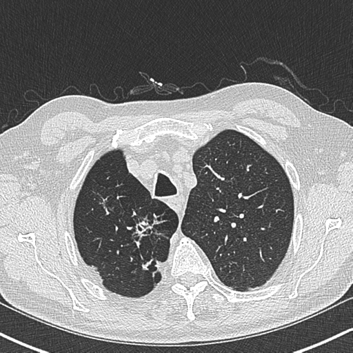Allergic bronchopulmonary aspergillosis (Radiopaedia 44760-48571 Axial lung window 14).png