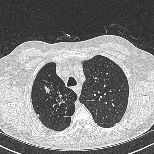 Allergic bronchopulmonary aspergillosis (Radiopaedia 44760-48571 Axial lung window 15).png