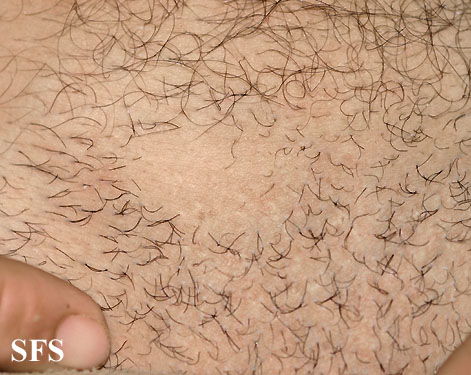 Alopecia Areata (Dermatology Atlas 30).jpg