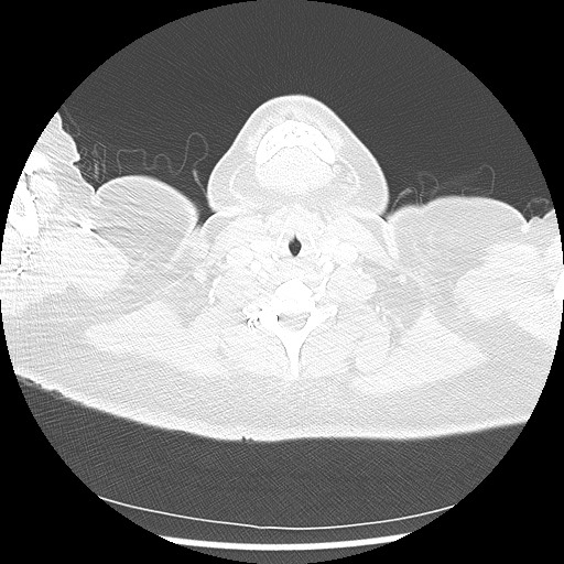 Alveolar soft part sarcoma - right leg (Radiopaedia 59432-67091 Axial lung window 1).jpg