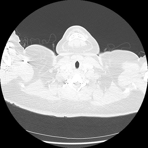 Alveolar soft part sarcoma - right leg (Radiopaedia 59432-67091 Axial lung window 3).jpg