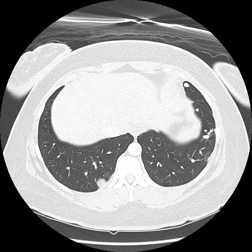 Alveolar soft part sarcoma - right leg (Radiopaedia 59432-67091 Axial lung window 92).jpg