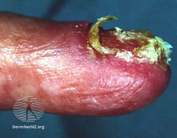 File:Amelanotic subungual melanoma (DermNet NZ lesions-mel11).jpg