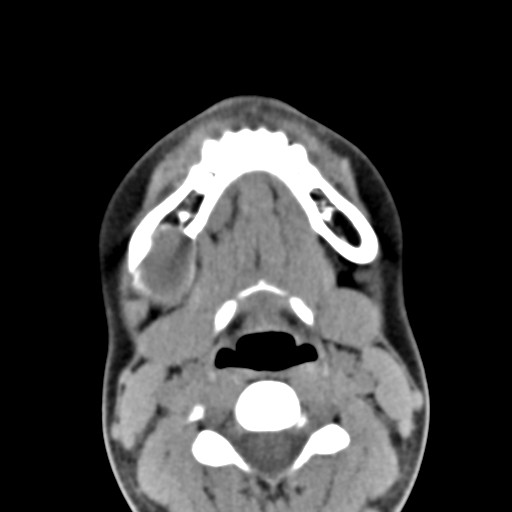 File:Ameloblastoma (Radiopaedia 26645-26793 Axial C+ delayed 11).jpg