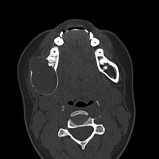 File:Ameloblastoma (Radiopaedia 26645-26793 E 32).jpg