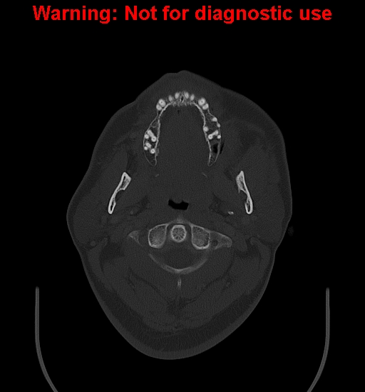 Ameloblastoma (Radiopaedia 33126-34164 Axial bone window 6).jpg