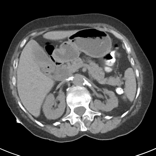 File:Ampullary adenocarcinoma (Radiopaedia 34013-35237 Axial non-contrast 18).png
