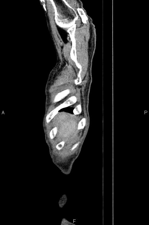 Ampullary adenocarcinoma (Radiopaedia 86093-102033 E 1).jpg