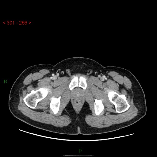 Ampullary carcinoma (Radiopaedia 56396-63056 C 105).jpg