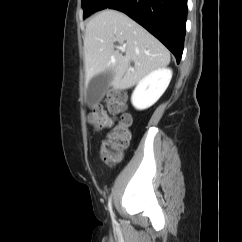 Ampullary tumor (Radiopaedia 22787-22816 D 15).jpg