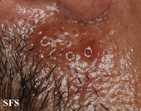 Amyloidosis-Nodular Amyloidosis (Dermatology Atlas 5).jpg