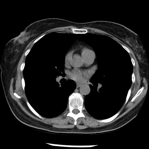 Amyloidosis - bronchial and diffuse nodular pulmonary involvement (Radiopaedia 60156-67744 Axial non-contrast 30).jpg