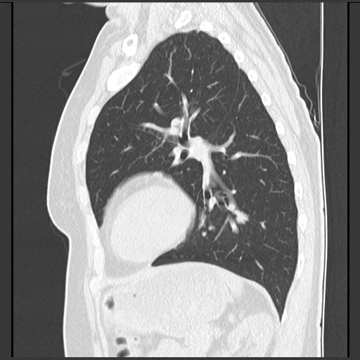 Amyloidosis - bronchial and diffuse nodular pulmonary involvement (Radiopaedia 60156-67744 F 39).jpg