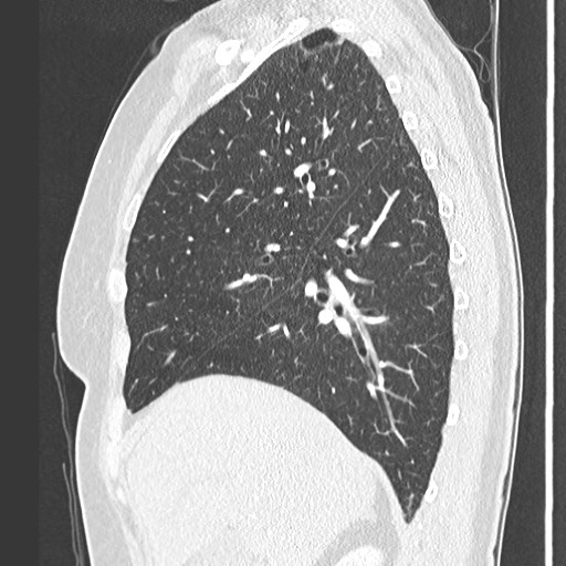 Amyloidosis - bronchial and diffuse nodular pulmonary involvement (Radiopaedia 60156-67745 Sagittal lung window 29).jpg