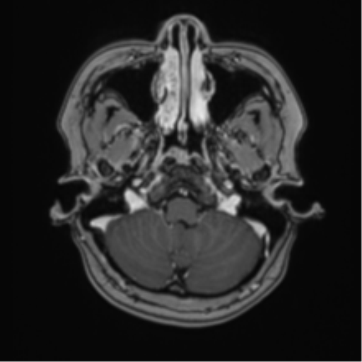 Anaplastic astroblastoma (Radiopaedia 55666-62194 Axial T1 C+ 13).png