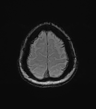 Anaplastic astrocytoma (Radiopaedia 86943-103160 Axial SWI 79).png