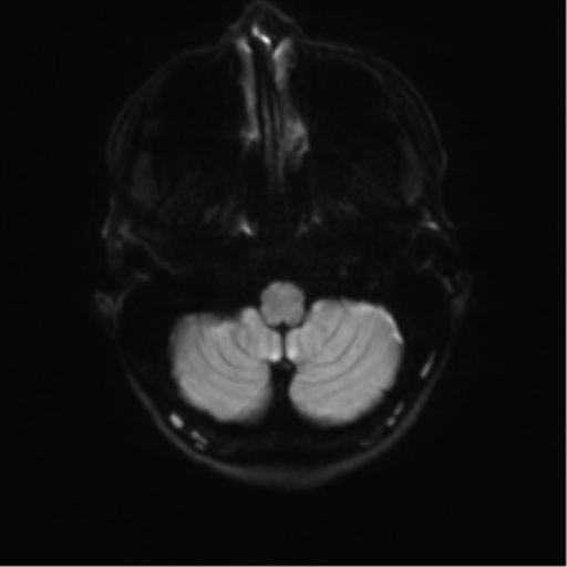 Anaplastic astrocytoma IDH mutant (Radiopaedia 50046-55341 Axial DWI 31).png