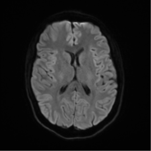Anaplastic astrocytoma IDH mutant (Radiopaedia 50046-55341 Axial DWI 43).png