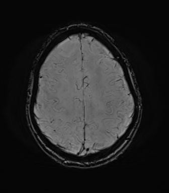 File:Anaplastic astrocytoma IDH mutant (Radiopaedia 50046-55341 Axial SWI 68).png