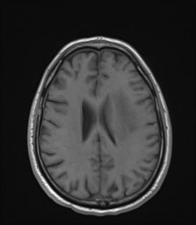 Anaplastic astrocytoma IDH wild-type (Radiopaedia 49984-55273 Axial T1 38).png