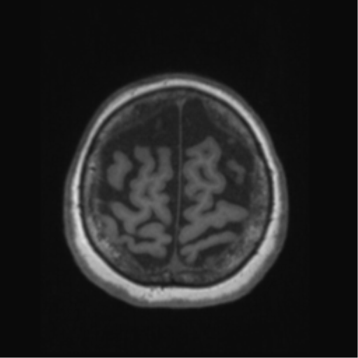 Anaplastic astrocytoma IDH wild-type (pseudoprogression) (Radiopaedia 42209-45276 Axial T1 128).png