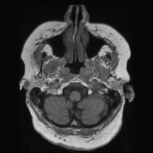 File:Anaplastic astrocytoma IDH wild-type (pseudoprogression) (Radiopaedia 42209-45278 Axial T1 28).png