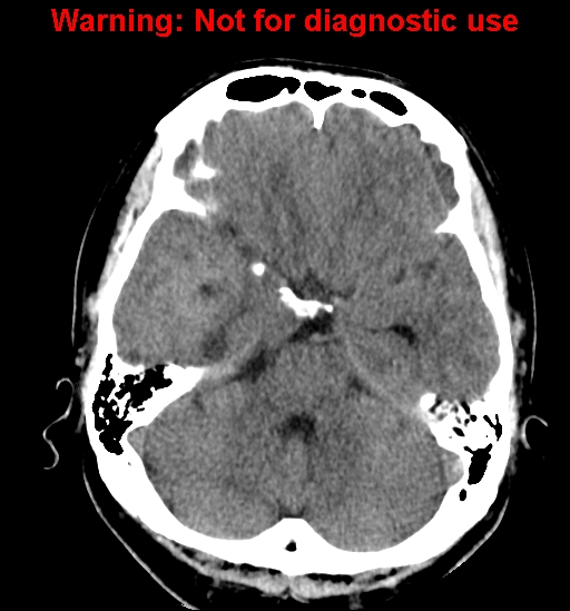 File:Anaplastic ganglioglioma (Radiopaedia 44921-48815 Axial non-contrast 8).jpg