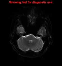 File:Anaplastic ganglioglioma (Radiopaedia 44921-48831 Axial DWI 38).jpg