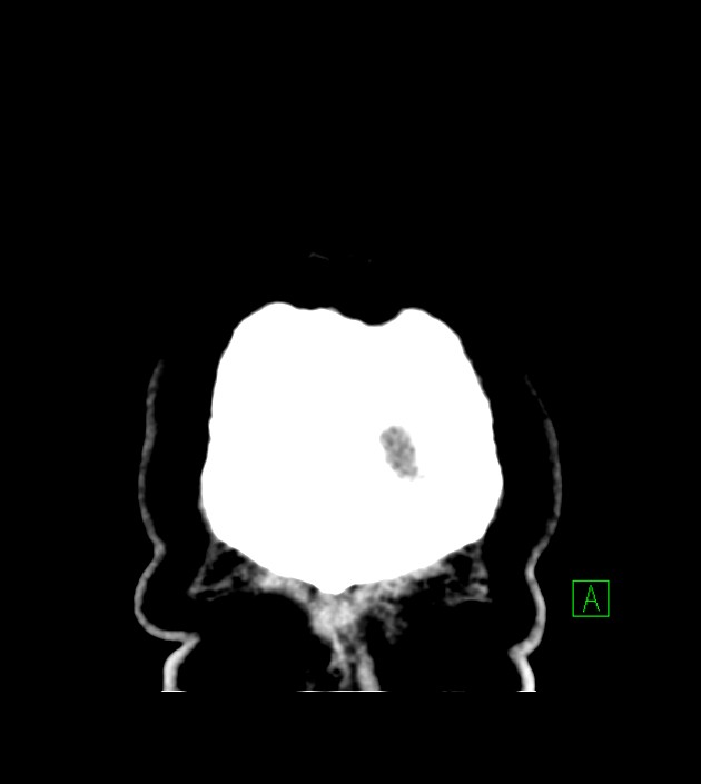 Anaplastic oligodendroglioma (Radiopaedia 79571-92758 Coronal non-contrast 64).jpg