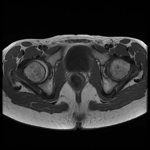 File:Androgen insensitivity syndrome (Radiopaedia 38585-40727 Axial T1 20).jpg