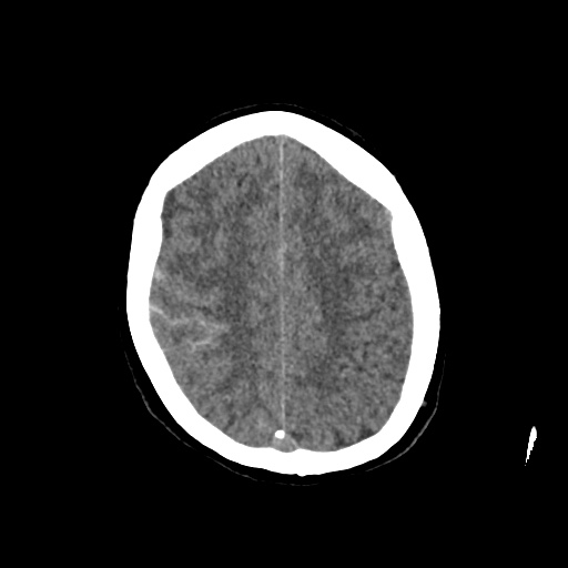 Aneursym related subarachnoid hemorrhage with hydrocephalus (Radiopaedia 45105-49083 Axial non-contrast 38).jpg