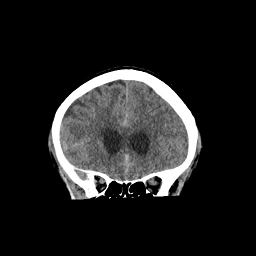 File:Aneursym related subarachnoid hemorrhage with hydrocephalus (Radiopaedia 45105-49083 Coronal non-contrast 19).jpg