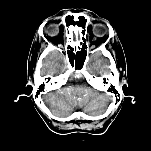 Aneursym related subarachnoid hemorrhage with hydrocephalus (Radiopaedia 45105-49084 D 11).jpg