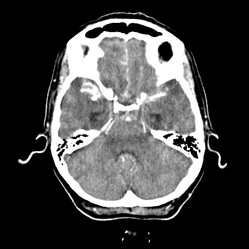 Aneursym related subarachnoid hemorrhage with hydrocephalus (Radiopaedia 45105-49084 D 15).jpg