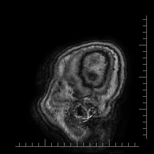 Aneurysm of posterior communicating artery (Radiopaedia 20188-20163 Sagittal T1 69).jpg