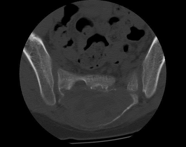Aneurysmal bone cyst - sacrum (Radiopaedia 65190-74195 Axial bone window 28).jpg