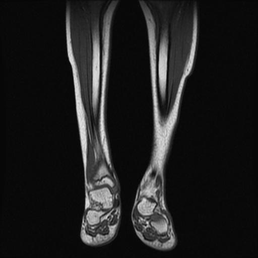 File:Aneurysmal bone cyst - tibia (Radiopaedia 22343-22367 Coronal T1 6).jpg