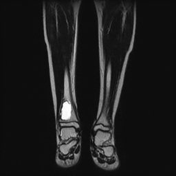 File:Aneurysmal bone cyst - tibia (Radiopaedia 22343-22367 Coronal T2 8).jpg