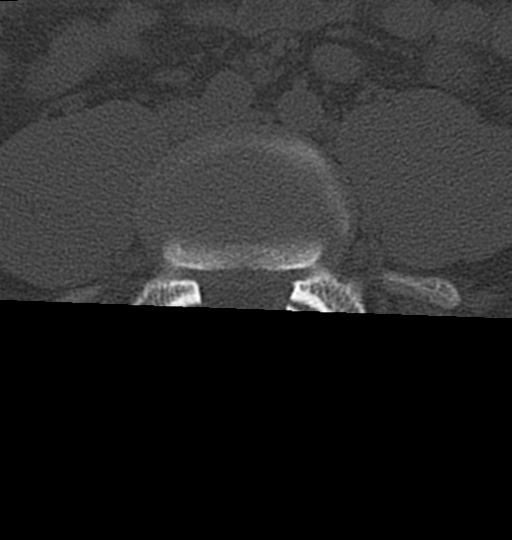 Aneurysmal bone cyst T11 (Radiopaedia 29294-29721 Axial bone window 106).jpg