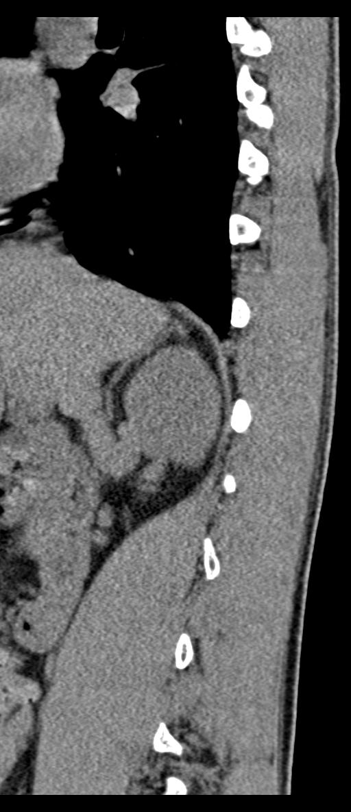 Aneurysmal bone cyst T11 (Radiopaedia 29294-29721 E 63).jpg