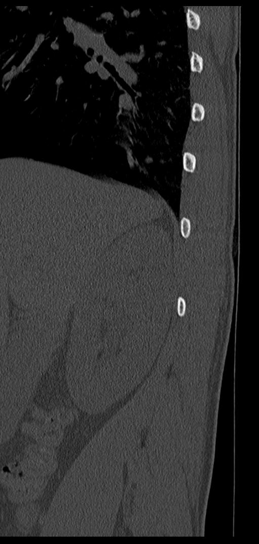 Aneurysmal bone cyst T11 (Radiopaedia 29294-29721 Sagittal bone window 77).jpg