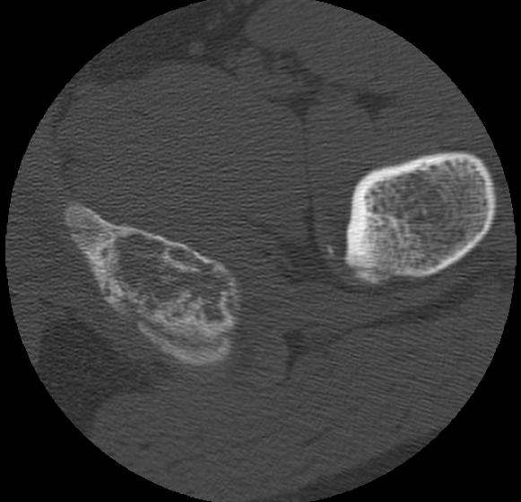 Aneurysmal bone cyst of ischium (Radiopaedia 25957-26094 B 49).png