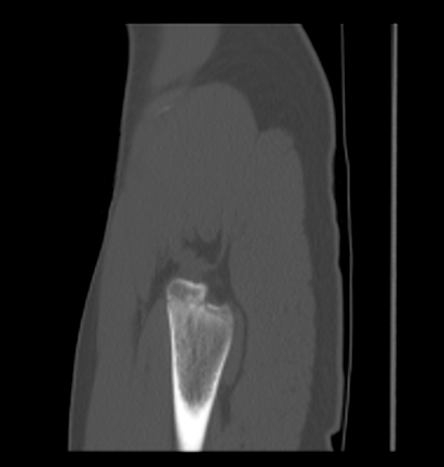 Aneurysmal bone cyst of ischium (Radiopaedia 25957-26094 Sagittal bone window 8).png