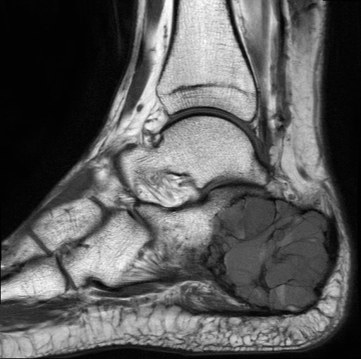 File:Aneurysmal bone cyst of the calcaneus (Radiopaedia 60669-68420 Sagittal T1 11).jpg