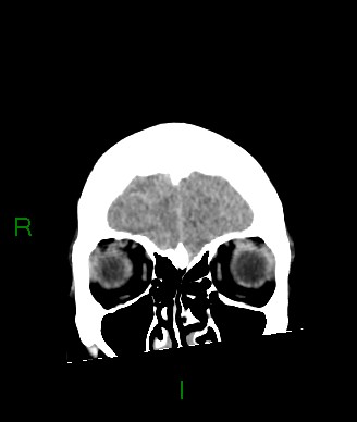 Aneurysmal subarachnoid hemorrhage with intra-axial extension (Radiopaedia 84371-99699 Coronal non-contrast 57).jpg