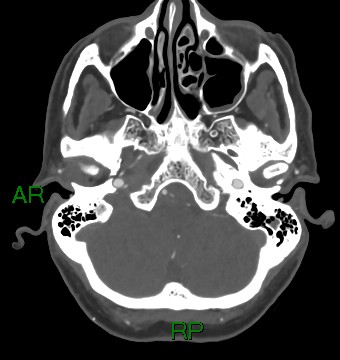 File:Aneurysmal subarachnoid hemorrhage with intra-axial extension (Radiopaedia 84371-99732 A 45).jpg