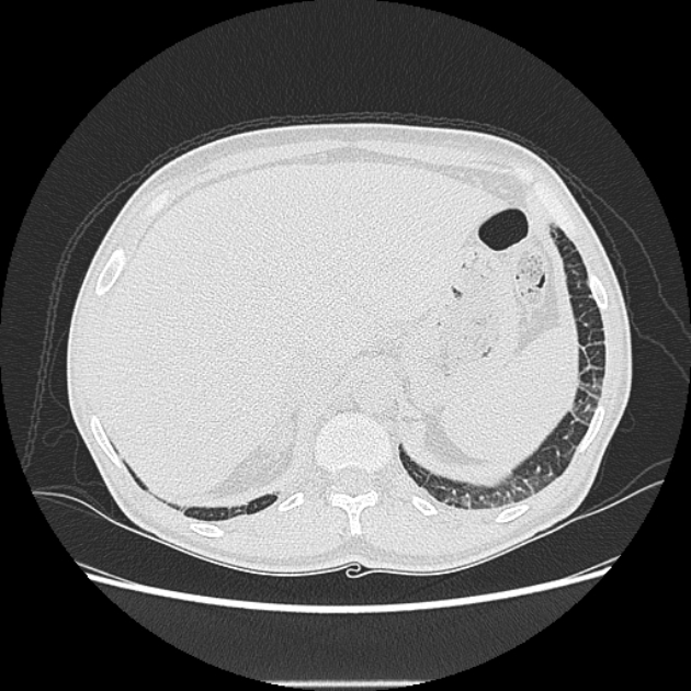 Angioinvasive aspergellosis (Radiopaedia 66995-76315 Axial lung window 49).jpg